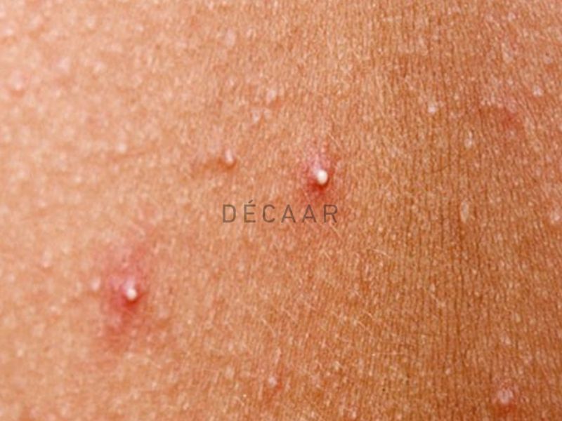 Một số loại thuốc có thể khiến hình thành mụn đầu trắng